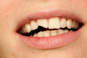 closeup of broken tooth in need of dental crown