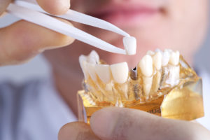 Dr. Cole recommends replacing teeth with dental implants in Farmington. 